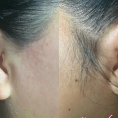 Facial hairline waxing before and after, OC