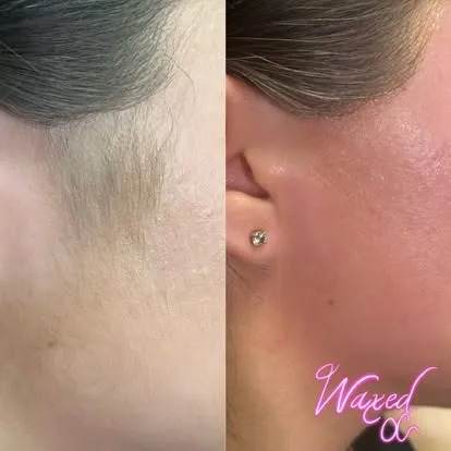 Sideburn and hairline waxing result