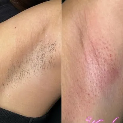 Underarm waxing before and after, Orange County
